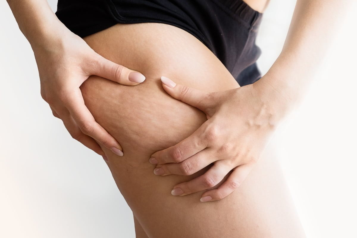 Cellulit – co&nbsp;to&nbsp;jest i&nbsp;jak z&nbsp;tym walczyć?