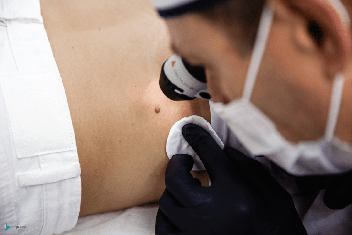 Jak odróżnić czerniaka od&nbsp;pieprzyka?