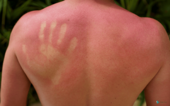 Oparzenia słoneczne – jak ich unikać i&nbsp;jak leczyć