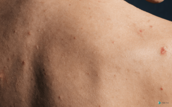 Trądzik na&nbsp;plecach – jakie są&nbsp;jego przyczyny i&nbsp;jak skutecznie z&nbsp;nim walczyć?