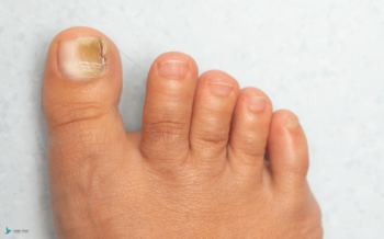 Jak wygląda grzybica paznokci?